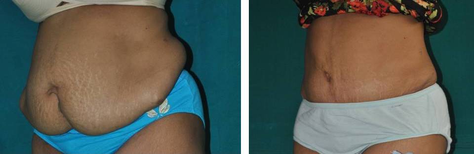 Tummy tuck abdominoplasty surgery in India